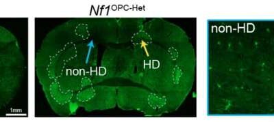Nf1 gene mutations disrupt brain cell plasticity and motor learning in mice