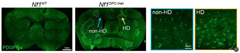 Nf1 gene mutations disrupt brain cell plasticity and motor learning in mice