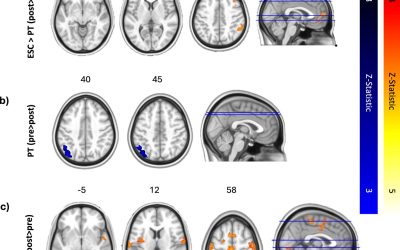 Psilocybin better preserves depressed patients’ emotional response to music than standard drug, study finds