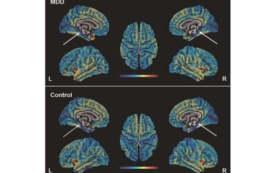 Brain scans reveal parahippocampal cortex thinning in those with depression and neuroticism