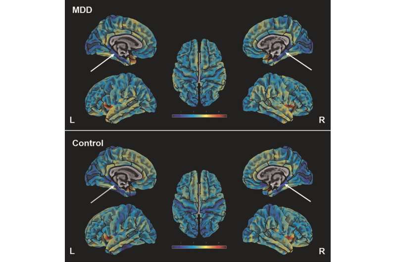 Brain scans reveal parahippocampal cortex thinning in those with depression and neuroticism